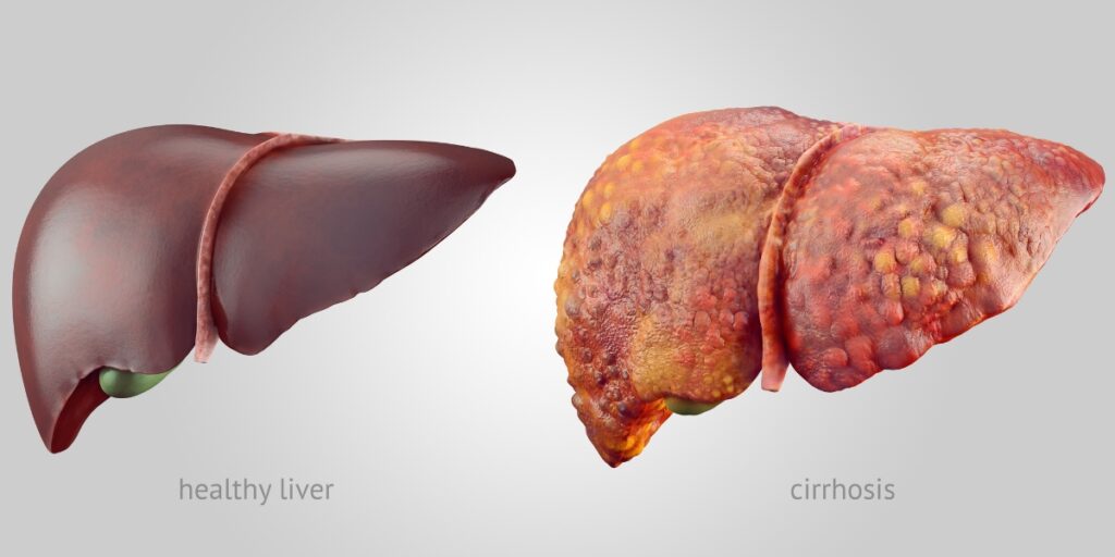 what does alcohol do to the liver